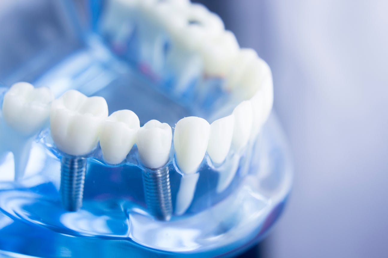 Cosmetic Dentistry and Implant Restorations